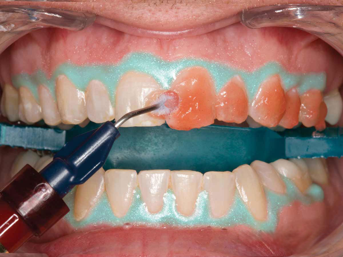 метод отбеливания зубов